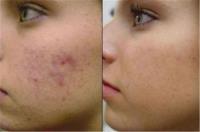Teen Acne Treatment And Facial image 6